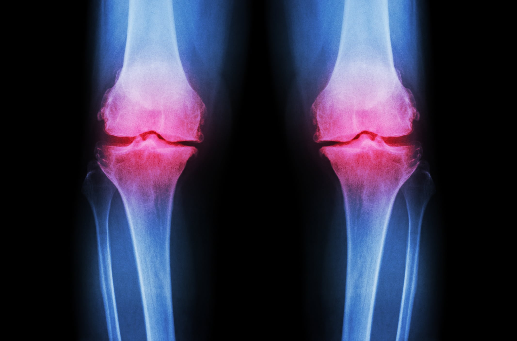 Knee-joint-C-Getty-Images-stockdevil.jpg