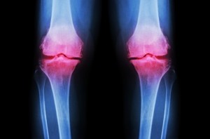 Knee joint © Getty Images stockdevil